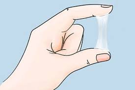 Khí hư bất thường (huyết trắng bệnh lý) - Hình ảnh minh họa